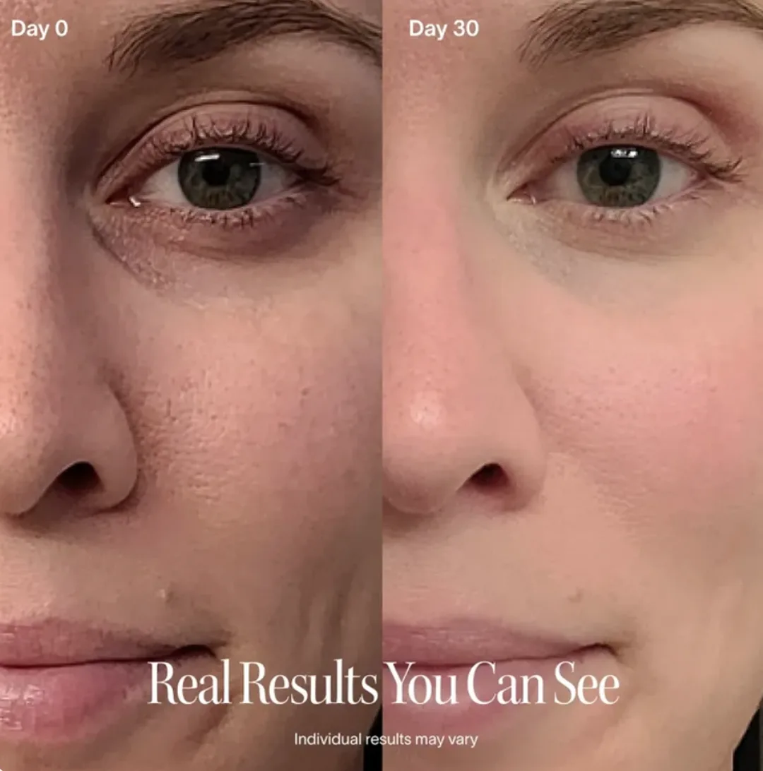 Under-eye area on day 0 compared with day 30 of the Flarelit ritual