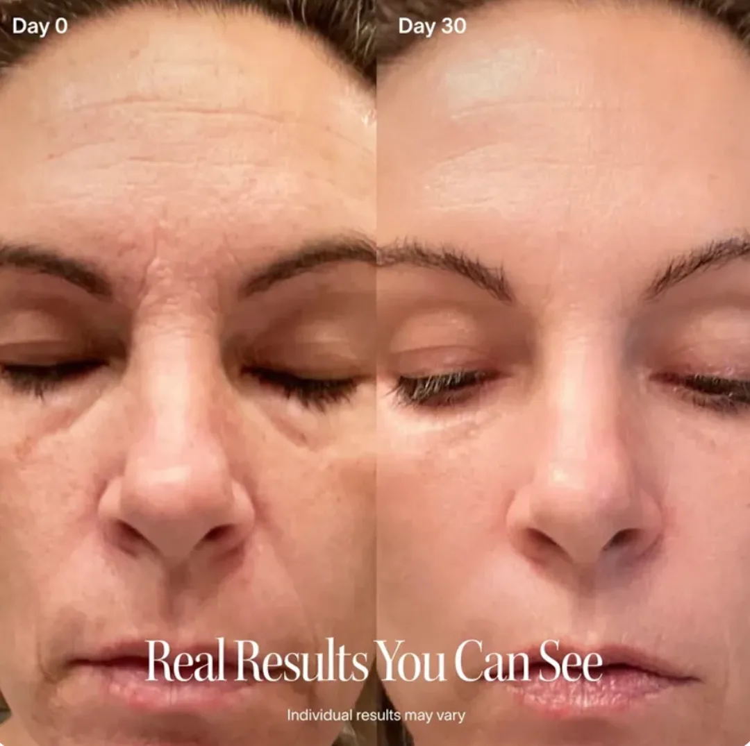 Forehead lines on day 0 compared with day 30 of the Flarelit ritual